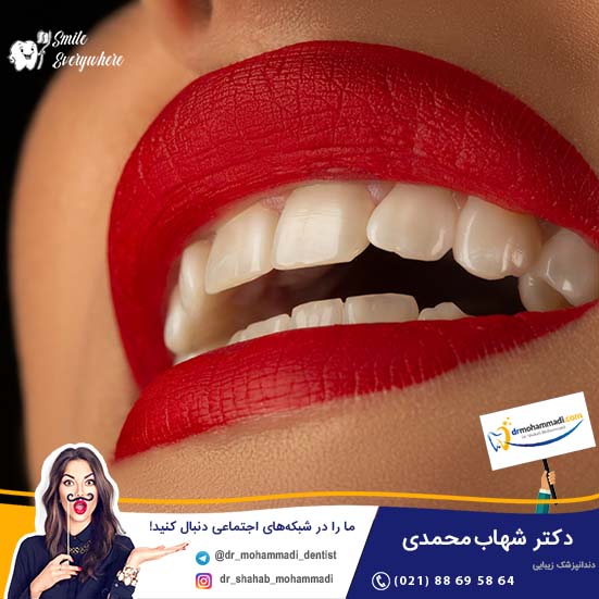 مراحل انجام کامپوزیت ونیر  - کلینیک دندانپزشکی دکتر شهاب محمدی